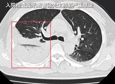 【警惕】珠海一男子这样吹空调被送入ICU！