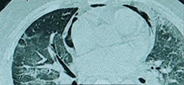 空调长期不洗男子吹空调后肺部感染险丧命