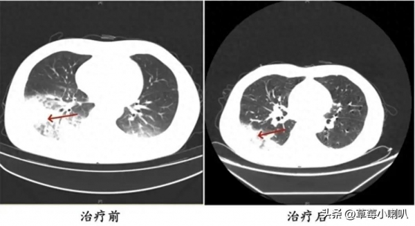 女子吹未清洗的空调致多器官衰竭为什么这么严重？空调应该怎么清理？(图2)