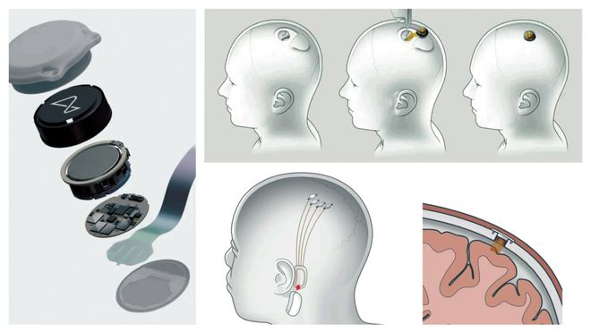 植入式脑机接口赋予人类“超能力”(图2)